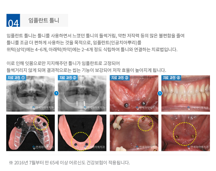 임플란트틀니