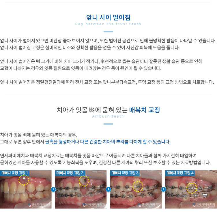앞니-사이-벌어짐 치아가-잇몸-뼈에-묻혀있는-매복치-교정
