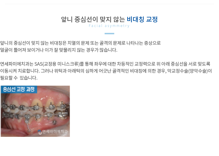 앞니-중심선이-맞지-않는-비대칭-교정