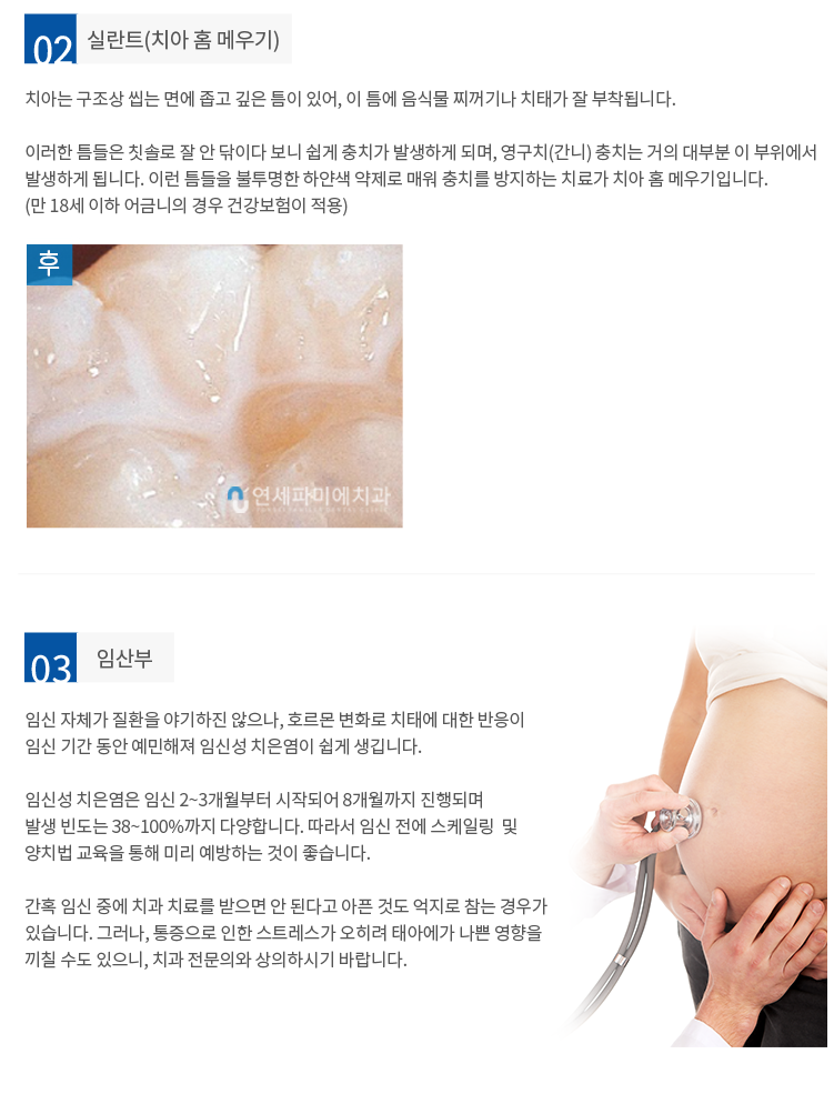 실란트 임산부-치은염